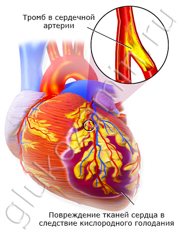 Инфаркт — прямое следствие ишемии тканей сердца