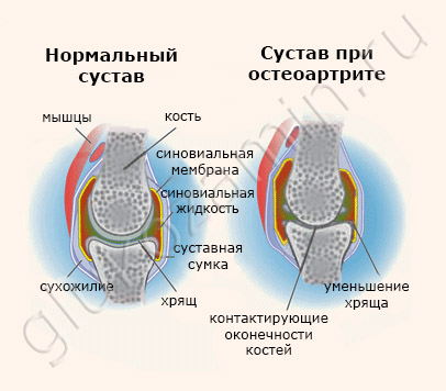 Нормальный и поражённый остеоартритом сустав