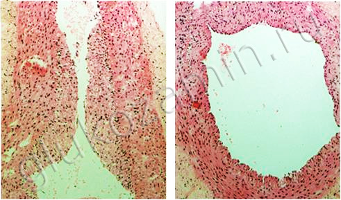 Слева: артерия кролика, поражённая атеросклерозом. Справа: она же после воздействия глюкозамина (G. Herrero-Beaumont, 2008)